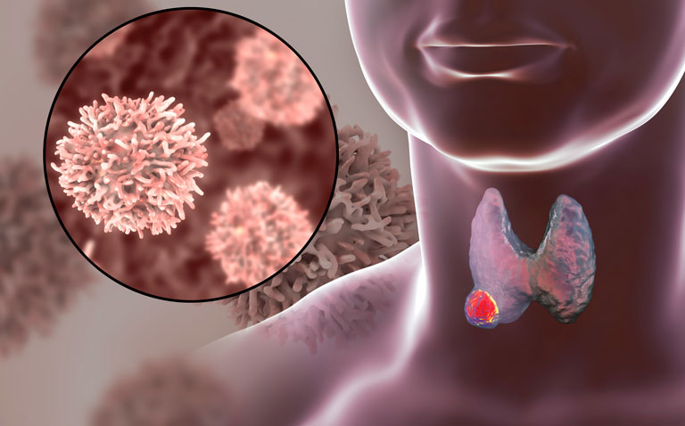 Radiofrequency ablation effective for low-risk thyroid papillary microcarcinoma