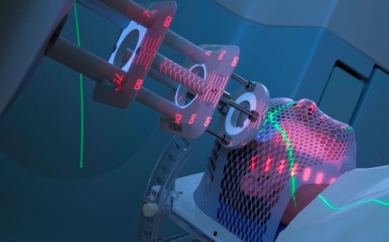 Radiotherapy use in cancer increases cardiovascular disease mortality risk