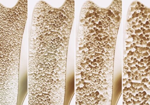A 3D rendering of four stages of osteoporosis to illustrate a landmark decision resulting from the SABRE project on recognising changes in total hip BMD as a new surrogate endpoint for fracture risk reduction in postmenopausal osteoporosis trials