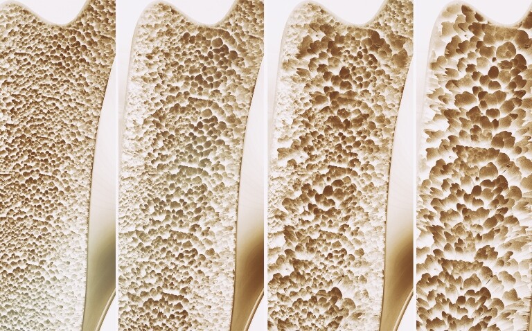 A 3D rendering of four stages of osteoporosis to illustrate a landmark decision resulting from the SABRE project on recognising changes in total hip BMD as a new surrogate endpoint for fracture risk reduction in postmenopausal osteoporosis trials