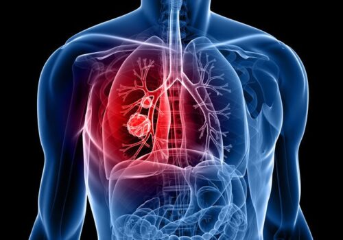 Residual ctDNA predicts relapse in lung cancer