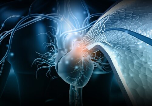 3D digital illustration of a human heart angioplasty stent implantation to illustrate rethinking cardiovascular interventions through insights from the inaugural EAPCI Summit