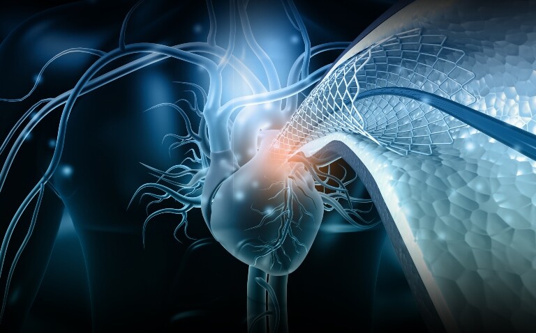 3D digital illustration of a human heart angioplasty stent implantation to illustrate rethinking cardiovascular interventions through insights from the inaugural EAPCI Summit