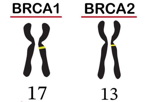 An illustration of chromosome 17 with the BRCA1 mutation highlighted and chromosome 13 with BRCA2 mutation highlighted to illustrate the finding that RRBM is linked with lower mortality in BRCA1 and BRCA2 carriers