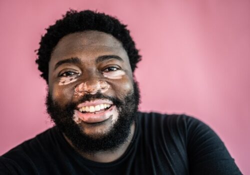 A close-up of a man with vitiligo to illustrate the NICE approval of ruxolitinib for non-segmental vitiligo