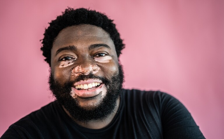 A close-up of a man with vitiligo to illustrate the NICE approval of ruxolitinib for non-segmental vitiligo