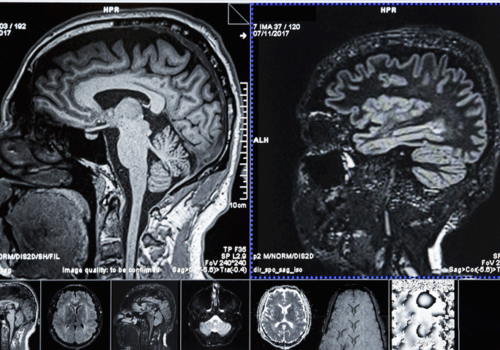 S100B measurement could reduce CT scan use by a quarter in low-risk head injuries
