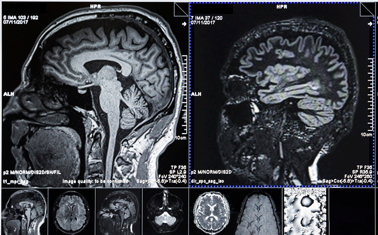 S100B measurement could reduce CT scan use by a quarter in low-risk head injuries