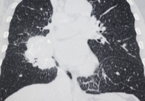 Systematic review suggests emphysema on CT scan associated with higher risk of lung cancer
