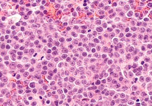 Tafasitamab shows best efficacy in refractory diffuse large B-cell lymphoma|Tafasitamab shows best efficacy in refractory diffuse large B-cell lymphoma