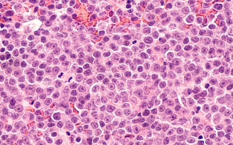 Tafasitamab shows best efficacy in refractory diffuse large B-cell lymphoma|Tafasitamab shows best efficacy in refractory diffuse large B-cell lymphoma