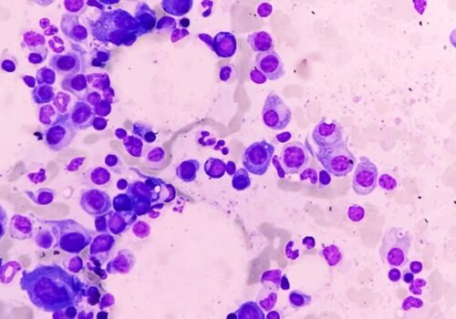 Talquetamab effective in relapsed/refractory multiple myeloma|Talquetamab effective in relapsed/refractory multiple myeloma