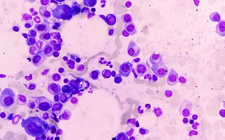Talquetamab effective in relapsed/refractory multiple myeloma|Talquetamab effective in relapsed/refractory multiple myeloma