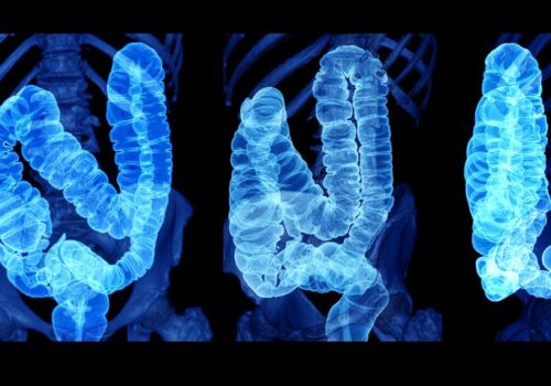 The Domino effect: COVID-19 and the implication on CRC screening