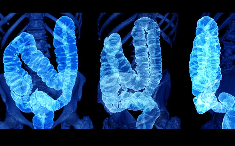 The Domino effect: COVID-19 and the implication on CRC screening