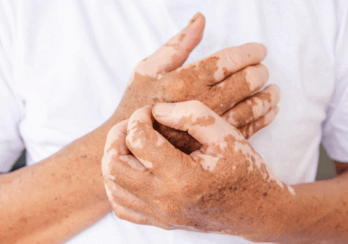 Topical ruxolitinib effective in non-segmental vitiligo