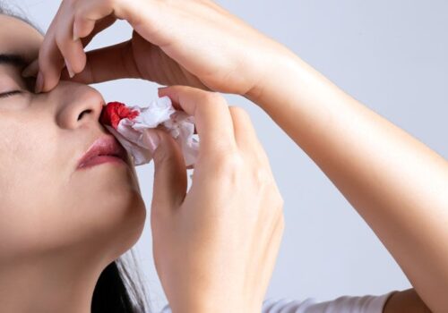Topical tranexamic acid effective for epistaxis