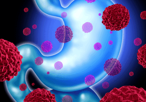 Trastuzumab deruxtecan treatment of advanced gastric cancer recommended for EU approval