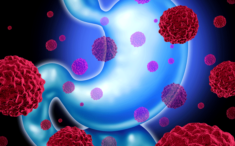 Trastuzumab deruxtecan treatment of advanced gastric cancer recommended for EU approval