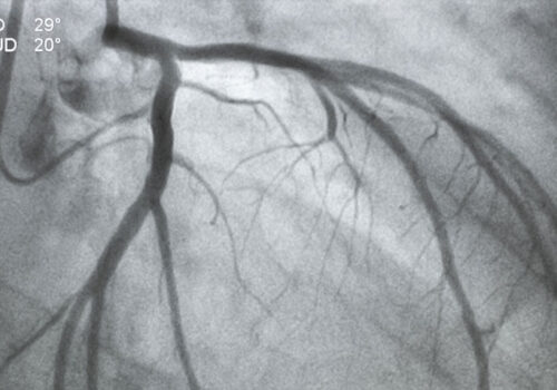 Ultrasonography guided femoral access fails to reduce bleeding rate in coronary angiography