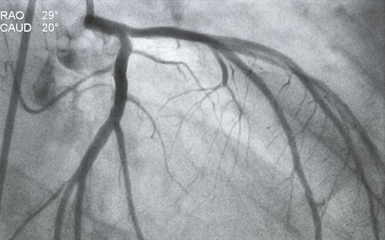 Ultrasonography guided femoral access fails to reduce bleeding rate in coronary angiography