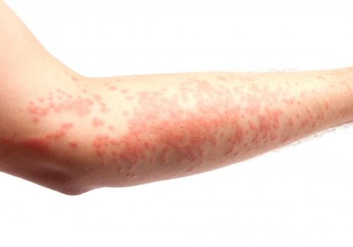 Chronic urticaria patients at risk of obstructive sleep apnoea