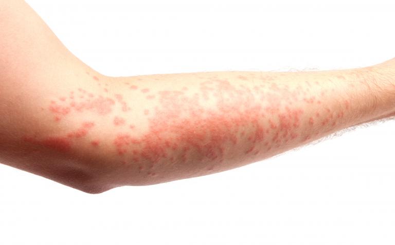 Chronic urticaria patients at risk of obstructive sleep apnoea
