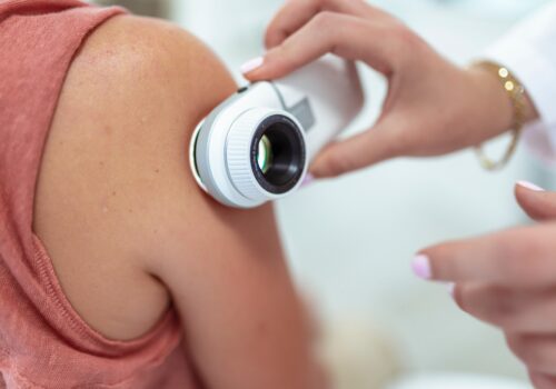 The dermatologist examines a mole on a patient's shoulder with a dermatoscope to illustrate the finding that AI skin cancer diagnostics fall short of expert physicians in a real-world assessment