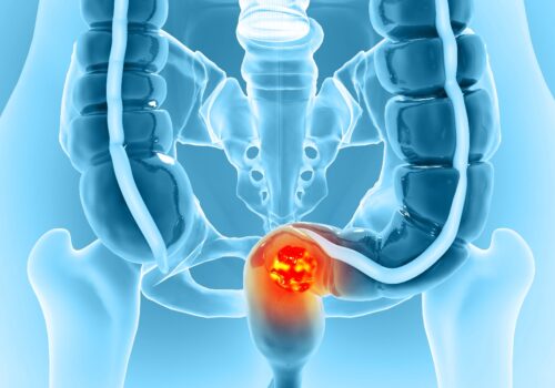 Medical illustration of the lower digestive tract and pelvis, with a bright red glowing tumour highlighted to illustrate the finding that Early-onset metastatic colorectal cancer is increasingly characterised by multi-site spread