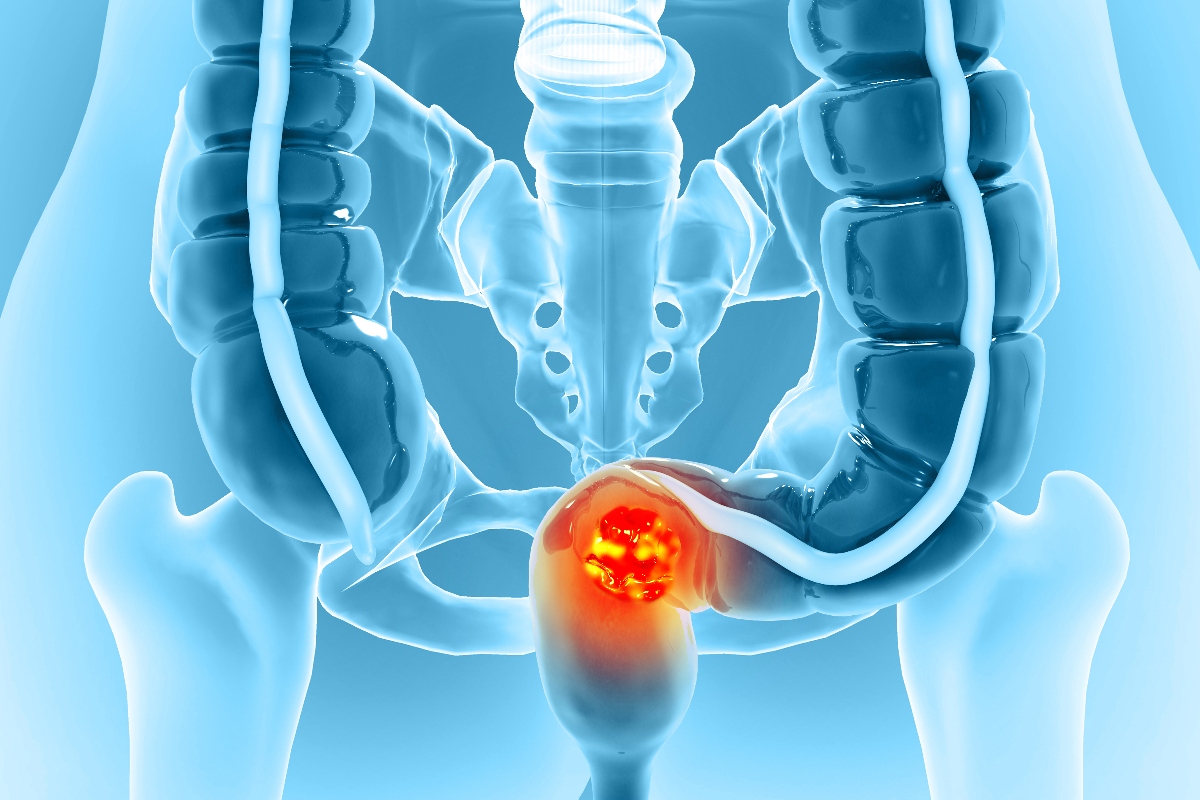Medical illustration of the lower digestive tract and pelvis, with a bright red glowing tumour highlighted to illustrate the finding that Early-onset metastatic colorectal cancer is increasingly characterised by multi-site spread