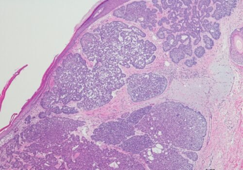 Microscopic photo of a professionally prepared slide of an H and E stain of basel cell carcinoma to illustrate the newer microscope technique EVCM shows high diagnostic accuracy
