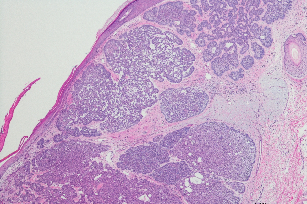 Newer microscope technique EVCM shows high diagnostic accuracy for basal cell carcinoma