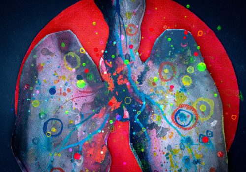 An artistic and abstract illustration depicting lungs affected by cancer to illustrate the finding that SABR and surgery show comparable outcomes for early-stage lung cancer with ILD