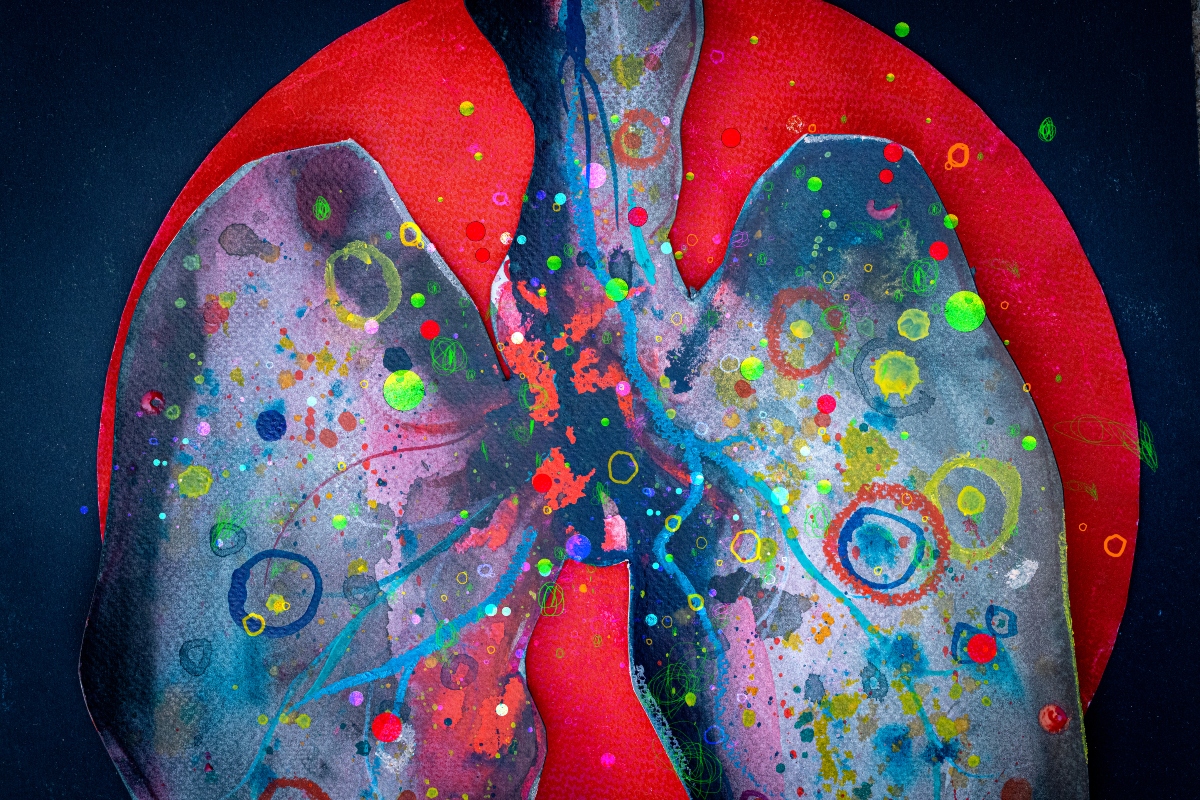 An artistic and abstract illustration depicting lungs affected by cancer to illustrate the finding that SABR and surgery show comparable outcomes for early-stage lung cancer with ILD