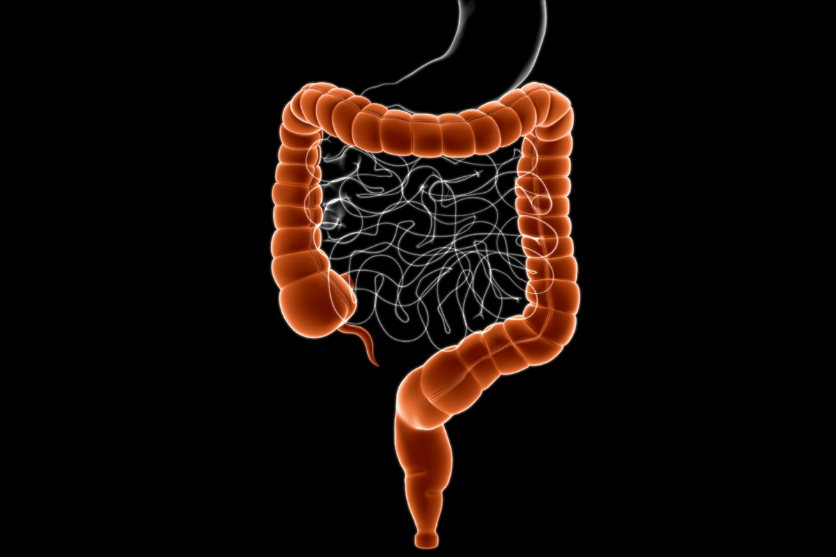 Upadacitinib demonstrates one-year effectiveness in refractory perianal Crohn’s disease